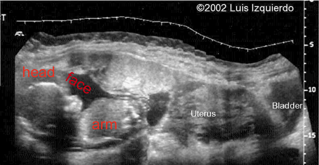 abdominal pregnancy